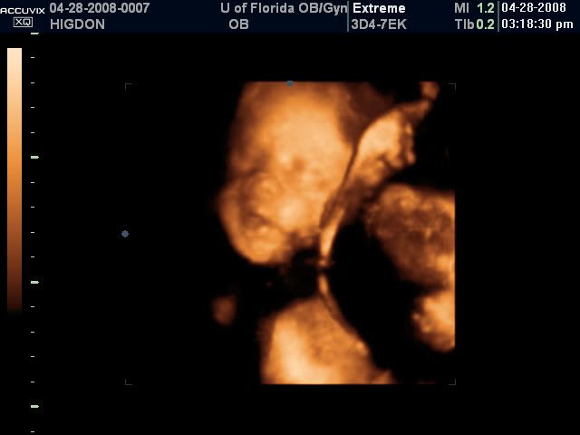 3d ultrasound pictures of twins. 3D ultrasound 28 weeks - TWINS